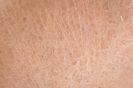 How Can I Combat Dry Skin Despite  My Moisturizing Efforts?