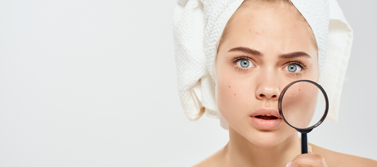 How to Remove Dark Spots Caused by Pimples