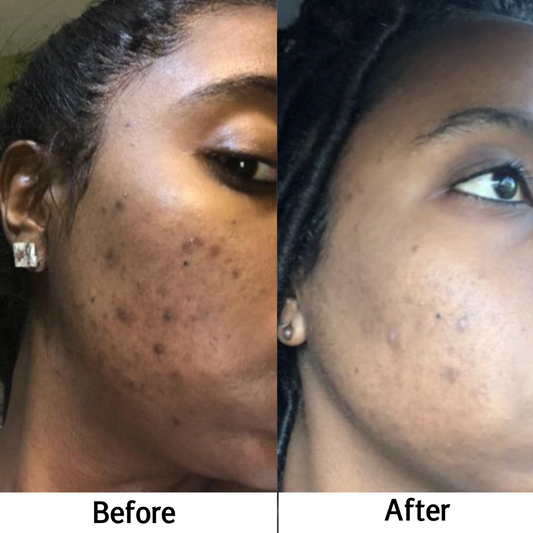 Testimonials and Success Stories: Real People, Real Results with Kojic Acid Soap