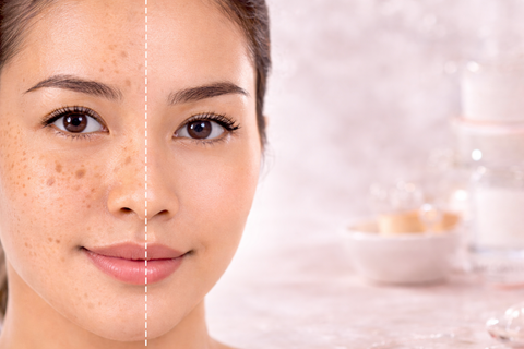 Does Kojic Acid Soap Work for Dark Spots and Hyperpigmentation?