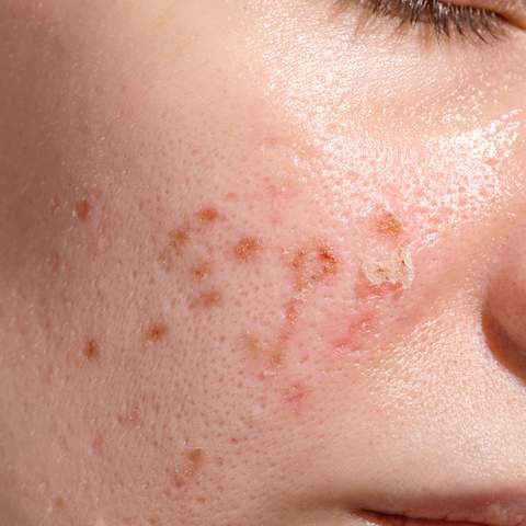 How to Support Skin Barrier Health with Koji White A Guide to Barrier Repair