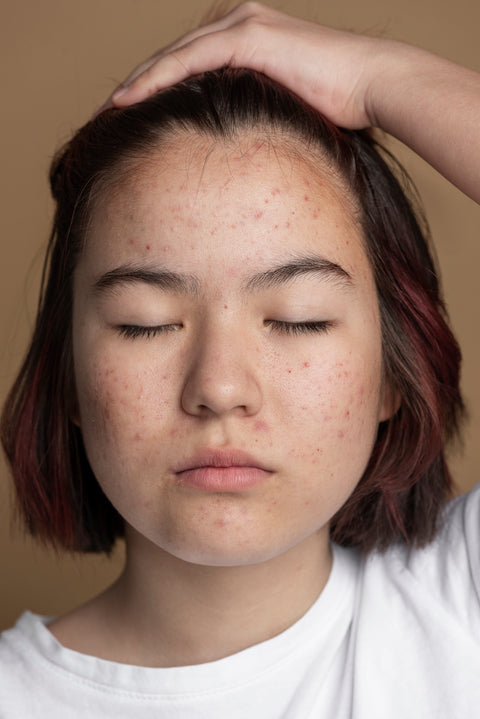 Eliminate Facial Spots & Boost Your Confidence