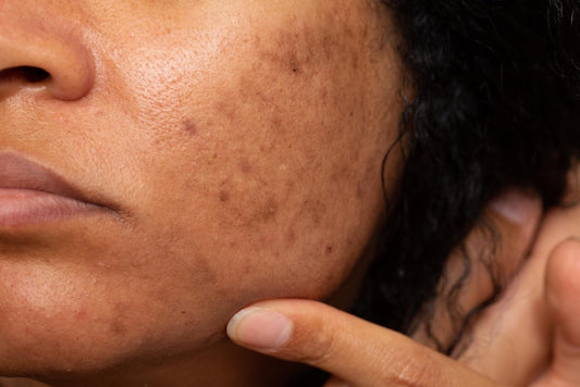 Why Do I Get Hyperpigmentation? Treatment, Causes, and Prevention
