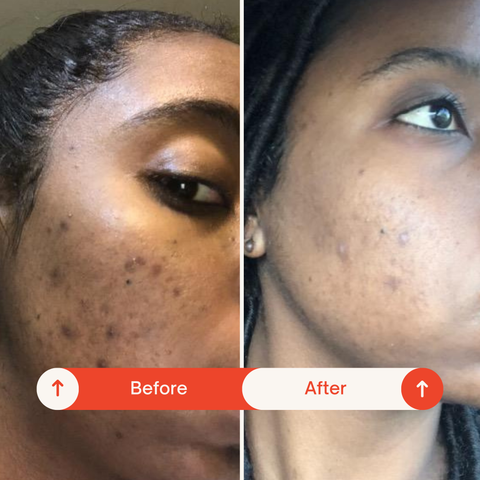 Hyperpigmentation