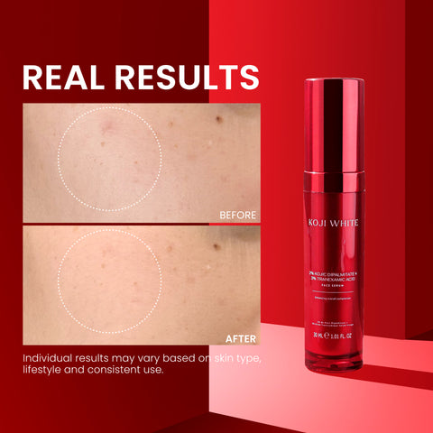 Koji White Pigment Face Correction Kit bundle with serum bottles and applicators for skin tone correction and brightening.
