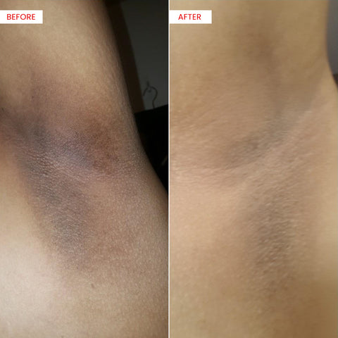 Koji White Bright Booster Underarm Serum (1 Bottle) - Koji White