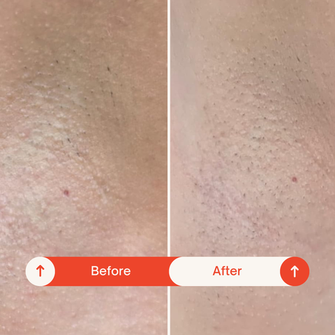 An excellent addition to my routine. It hasn't caused any irritation or redness, and my underarm skin feels noticeably softer. The before and after photo shows a nice brightening effect—even though lighting plays a part, the actual texture and tone improvement is there. It can be slightly drying, so just make sure to pair it with a good moisturizer or deodorant after it absorbs.