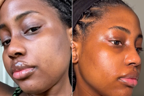 "I had purchased acid soap in the past, but couldn't find anything that actually would lighten my blemishes. I get mosquito bites often and they leave scars that heal poorly. Been using this on old scars and my skin appears vastly improved. The blemishes won't disappear, but the Koji Soap does work to minmize their appearance."